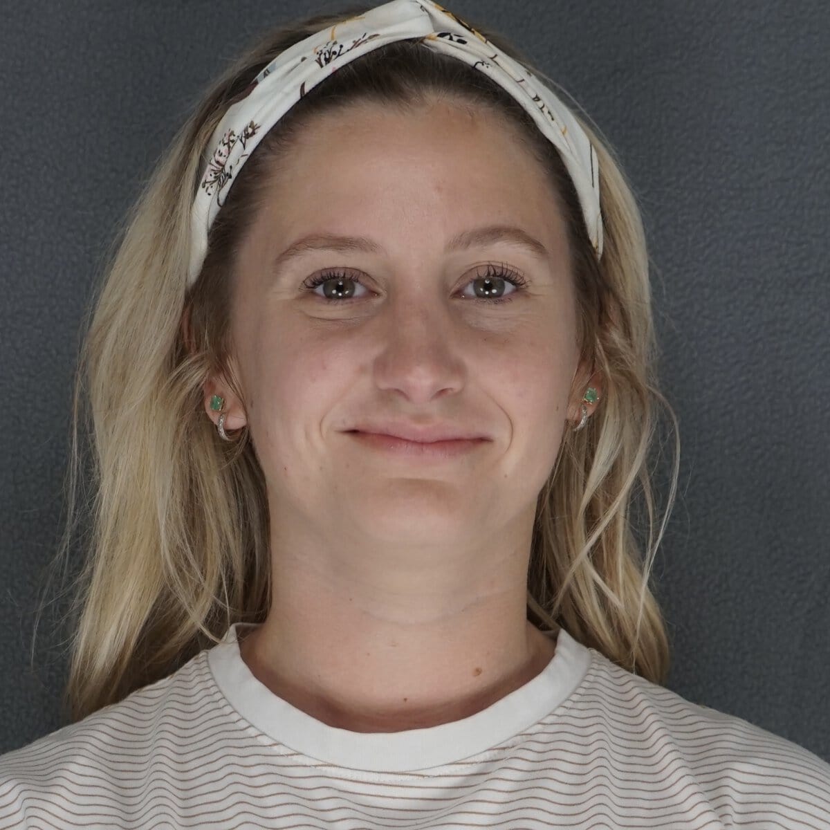 30 year old woman rhinoplasty dorsal bump nasal tip after natural results - Dr. Elkowitz Great Neck NY – front view post op